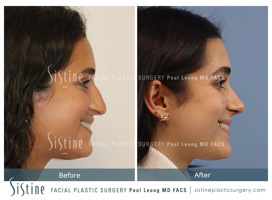 Rhinoplasty Before and After | Leong Facial Plastic Surgery