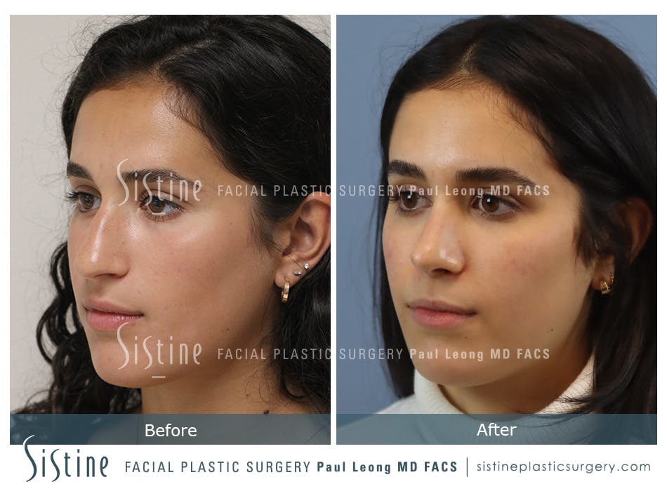 Rhinoplasty Before and After | Leong Facial Plastic Surgery