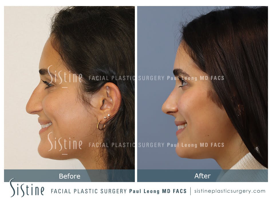 Rhinoplasty Before and After | Leong Facial Plastic Surgery