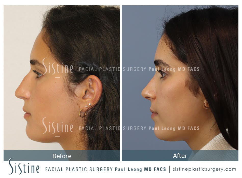 Rhinoplasty Before and After | Leong Facial Plastic Surgery