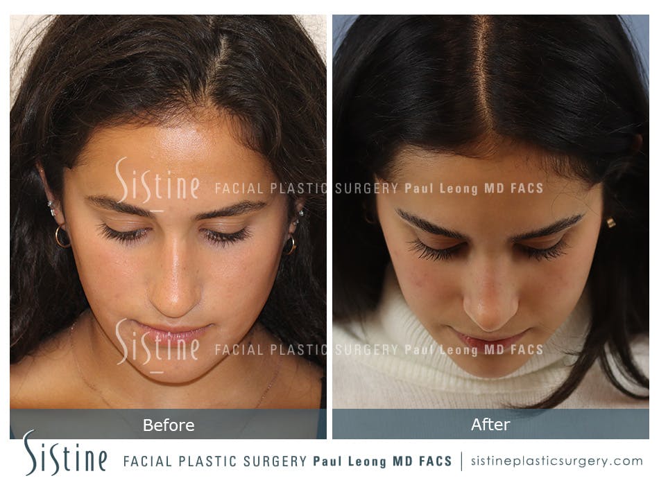 Rhinoplasty Before and After | Leong Facial Plastic Surgery