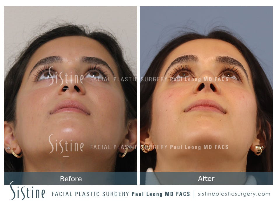 Rhinoplasty Before and After | Leong Facial Plastic Surgery