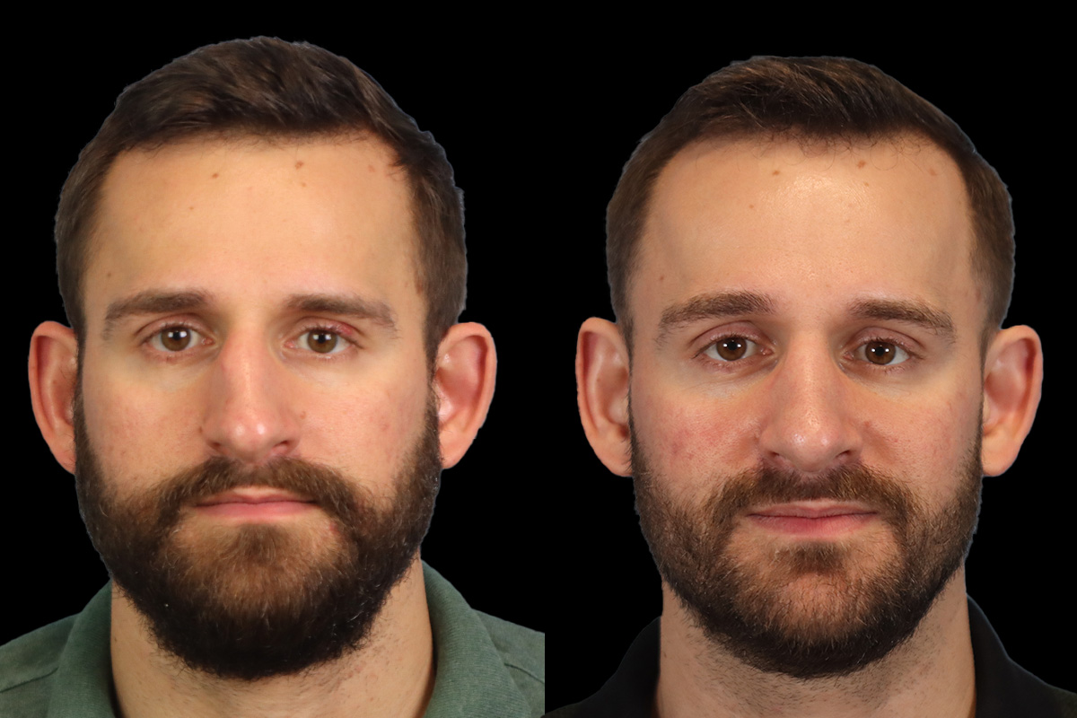 Rhinoplasty Before and After | Leong Facial Plastic Surgery