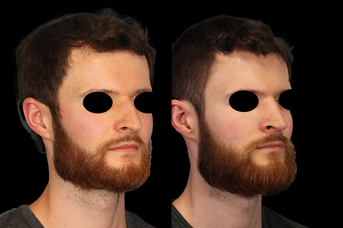 Rhinoplasty Before and After | Leong Facial Plastic Surgery