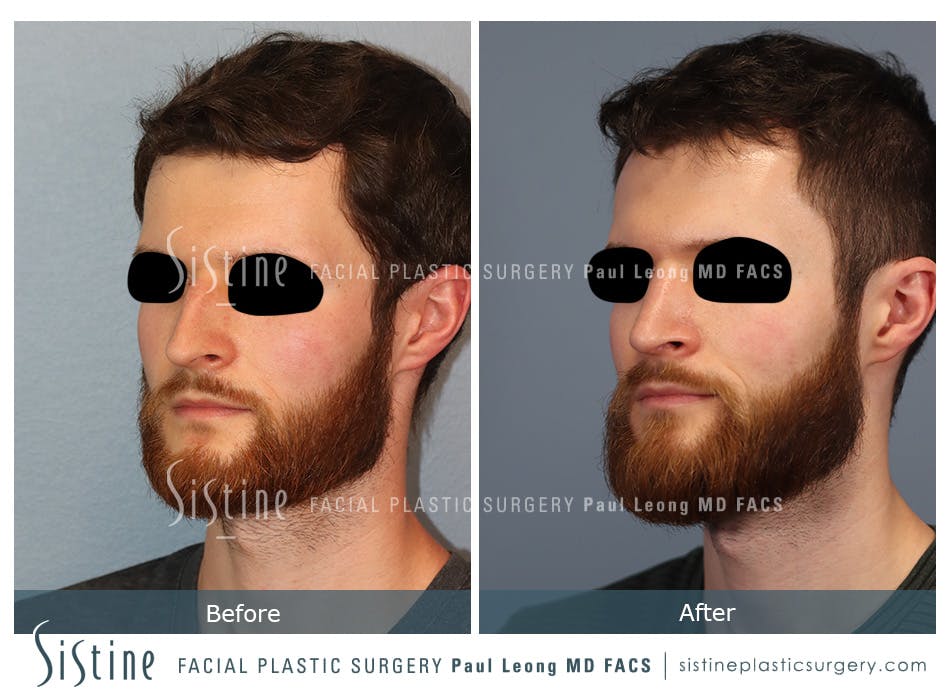 Rhinoplasty Before and After | Leong Facial Plastic Surgery
