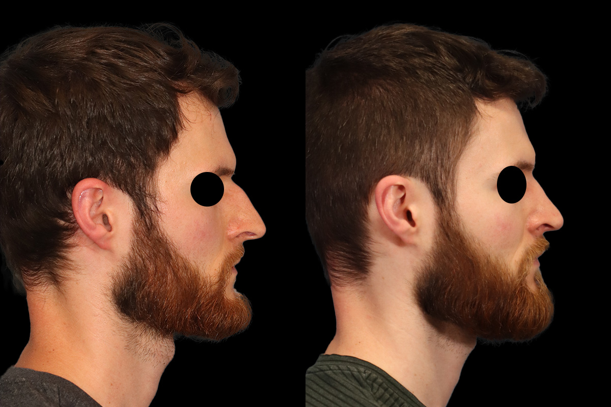 Rhinoplasty Before and After | Leong Facial Plastic Surgery