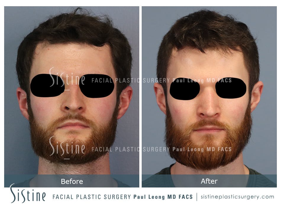 Rhinoplasty Before and After | Leong Facial Plastic Surgery