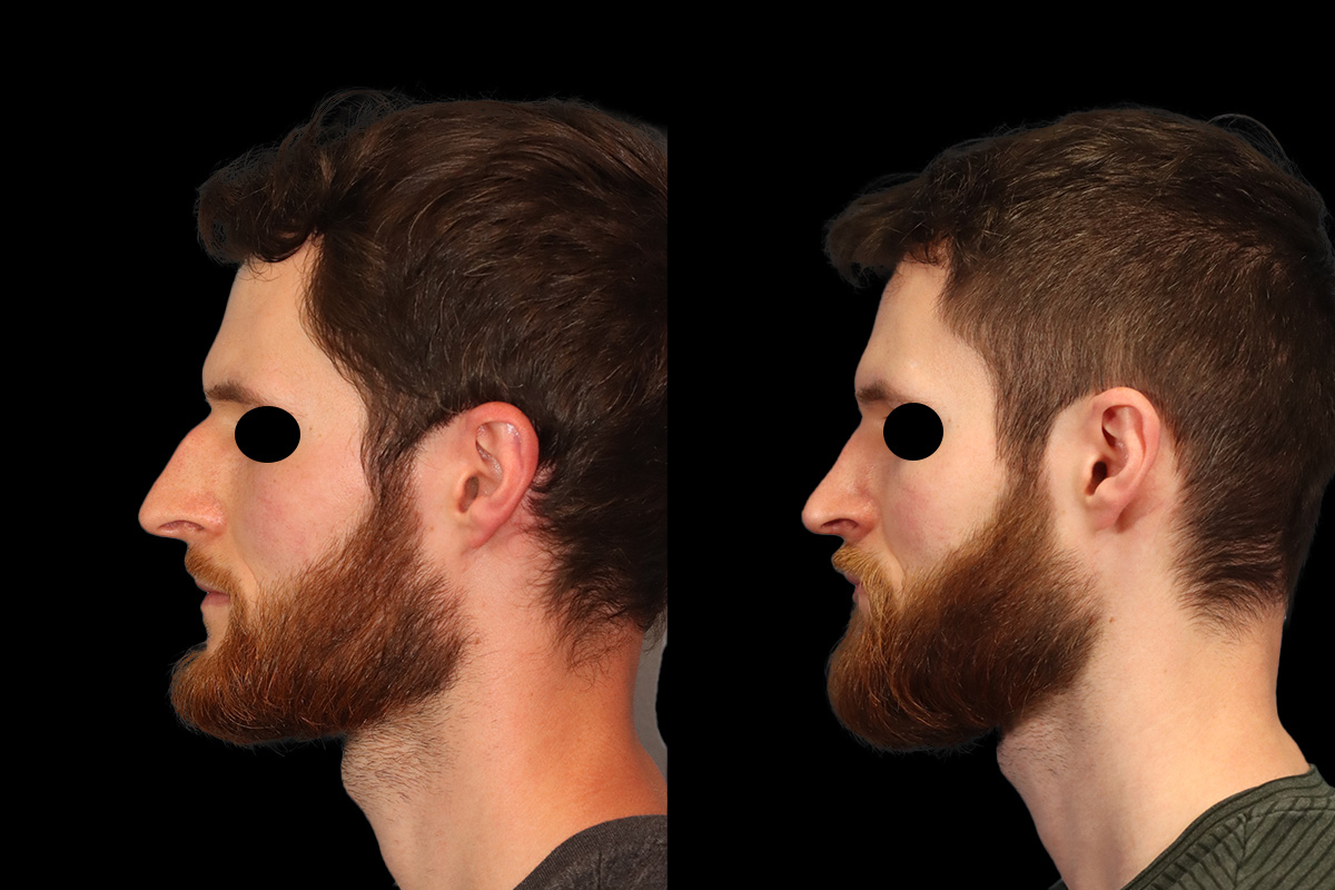 Rhinoplasty Before and After | Leong Facial Plastic Surgery