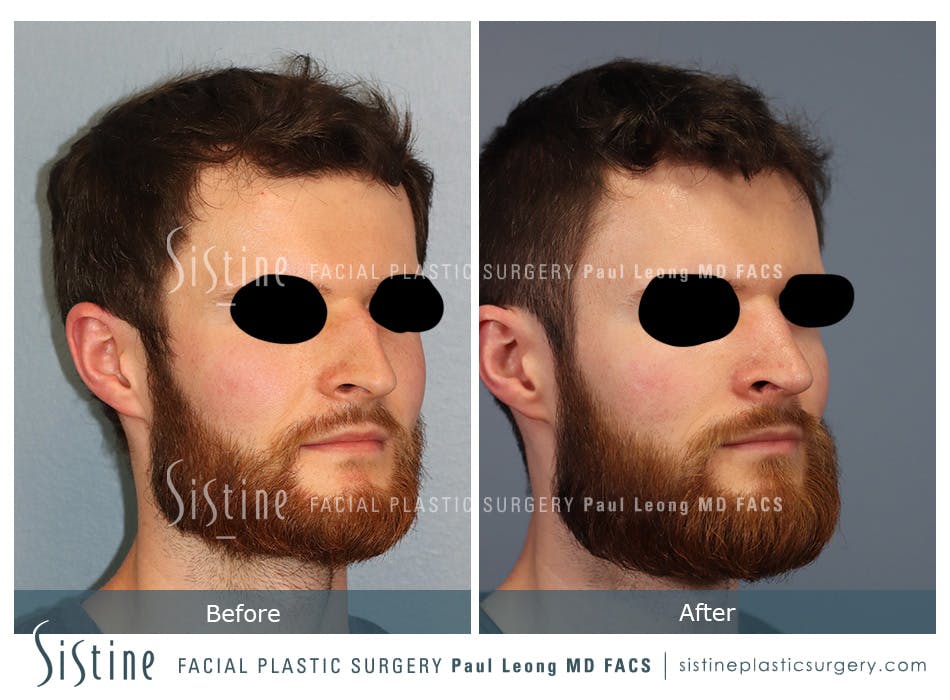 Rhinoplasty Before and After | Leong Facial Plastic Surgery