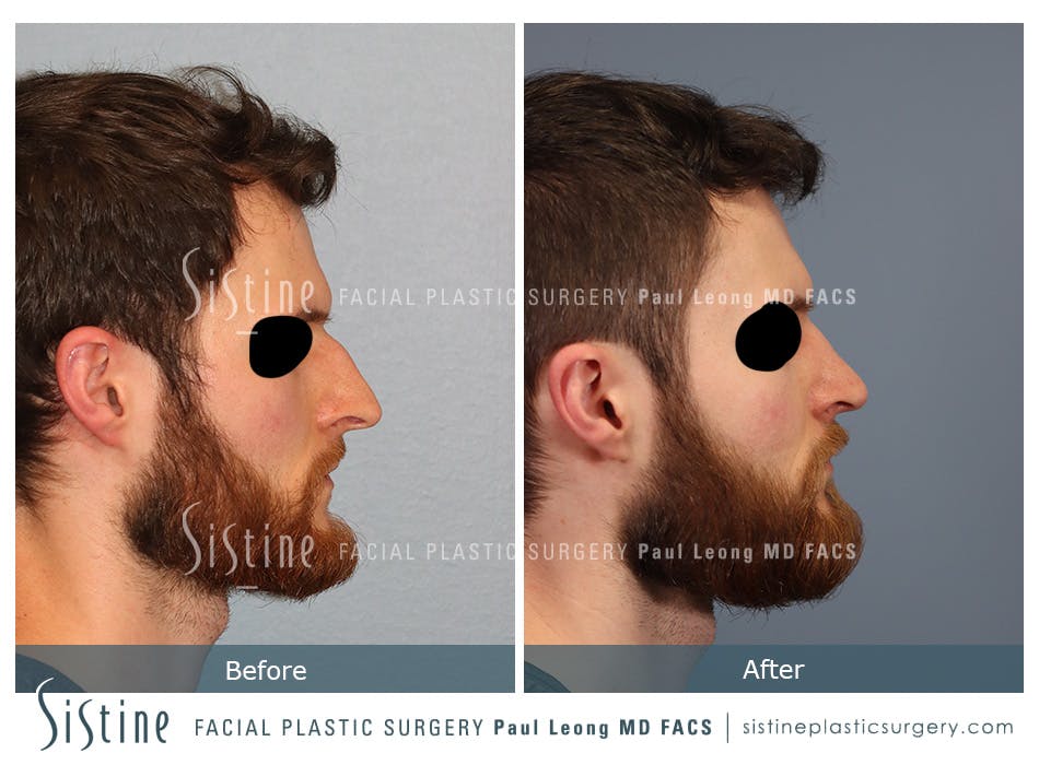 Rhinoplasty Before and After | Leong Facial Plastic Surgery