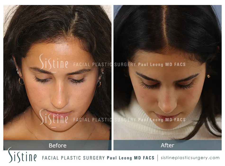 Nose Changes With Age - Preoperative View | Dr. Paul Leong