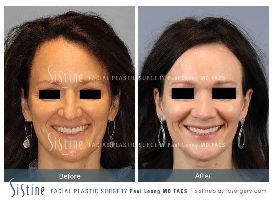 Rhinoplasty Before and After | Leong Facial Plastic Surgery