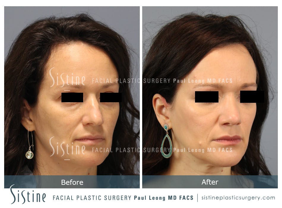 Rhinoplasty Before and After | Leong Facial Plastic Surgery