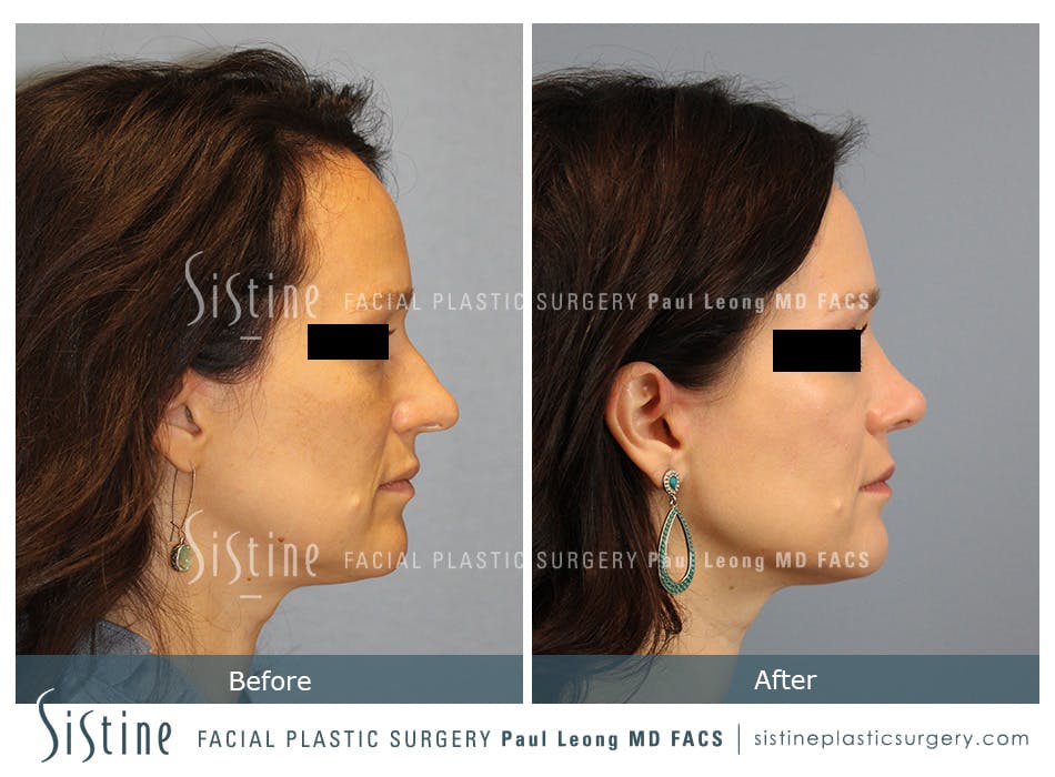 Rhinoplasty Before and After | Leong Facial Plastic Surgery
