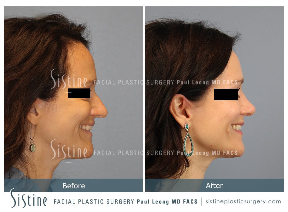 Rhinoplasty Before and After | Leong Facial Plastic Surgery