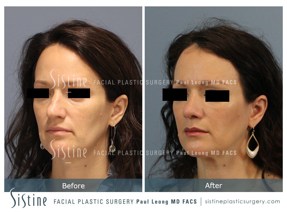 Rhinoplasty Before and After | Leong Facial Plastic Surgery