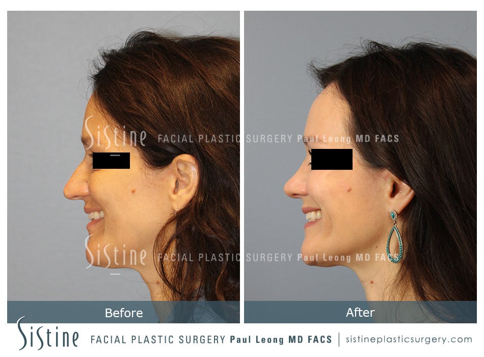 Rhinoplasty Before and After | Leong Facial Plastic Surgery