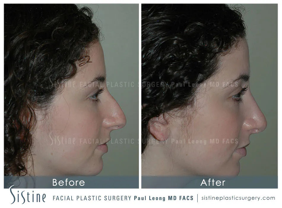 Rhinoplasty Before and After | Leong Facial Plastic Surgery