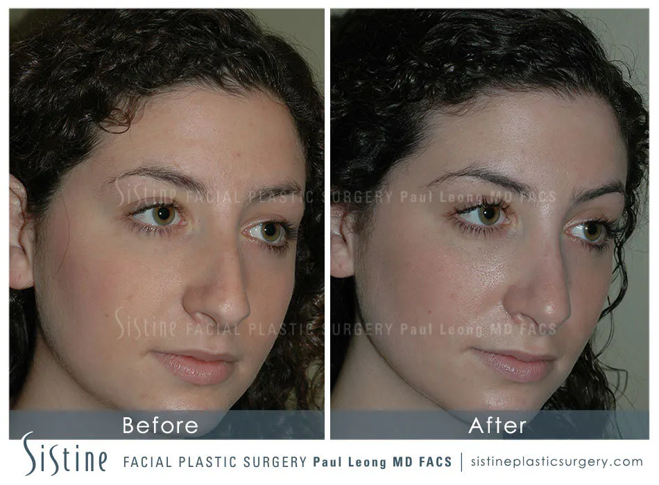 Rhinoplasty Before and After | Leong Facial Plastic Surgery