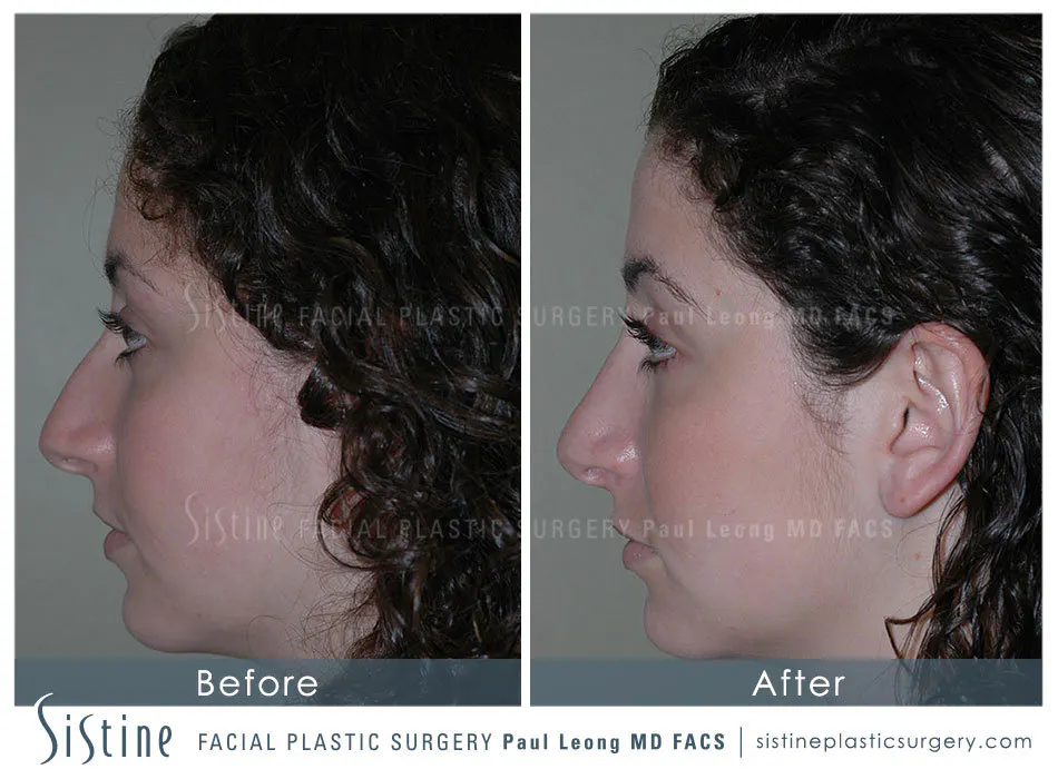 Rhinoplasty Before and After | Leong Facial Plastic Surgery