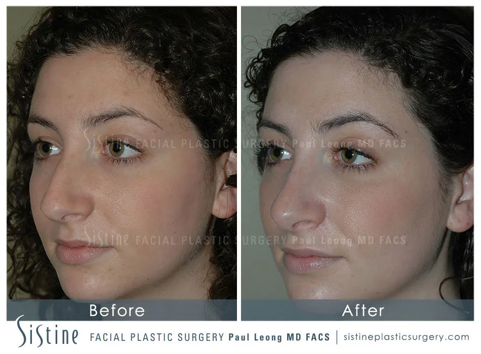 Rhinoplasty Before and After | Leong Facial Plastic Surgery