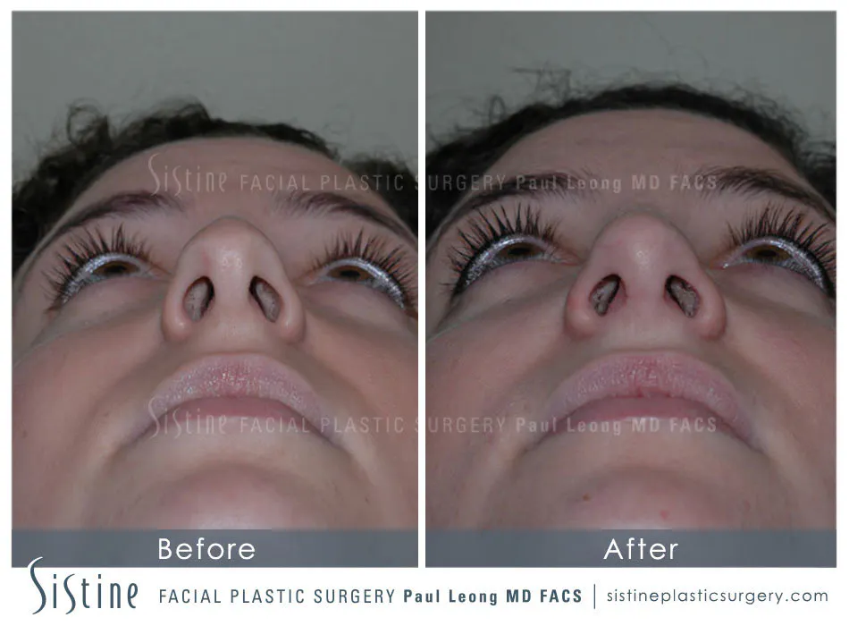 Rhinoplasty Before and After | Leong Facial Plastic Surgery