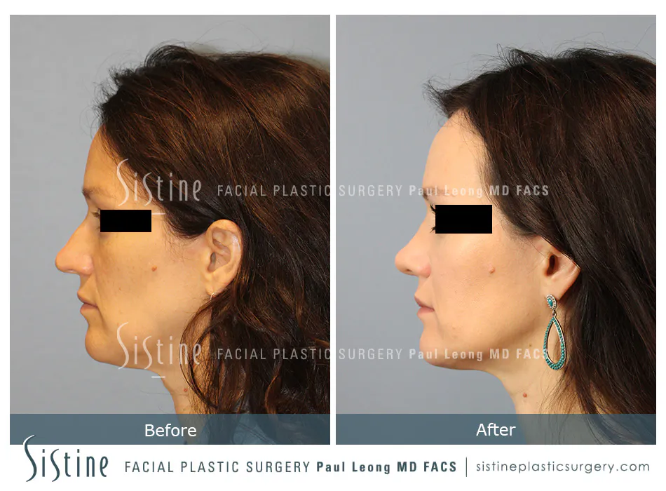 Female Rhinoplasty - Patient Preoperative View | Dr. Paul Leong