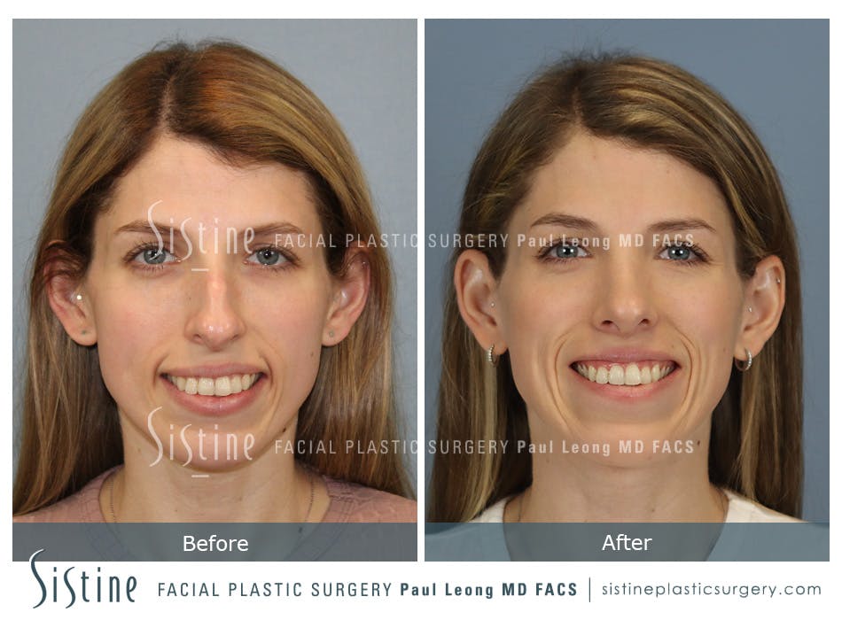 Rhinoplasty Before and After | Leong Facial Plastic Surgery