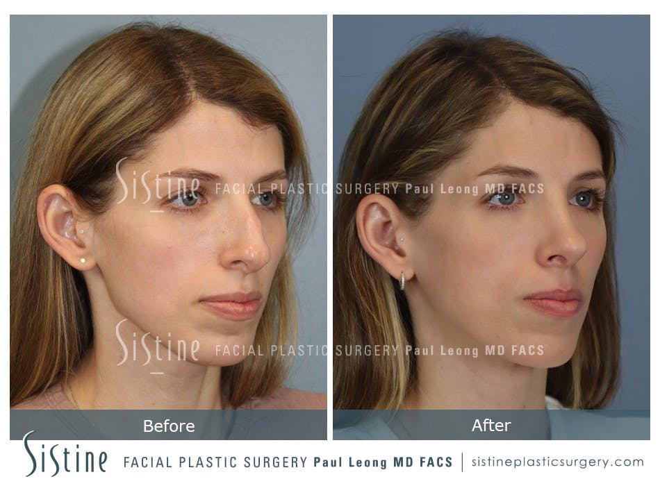 Rhinoplasty Before and After | Leong Facial Plastic Surgery