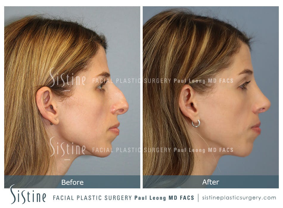 Rhinoplasty Before and After | Leong Facial Plastic Surgery