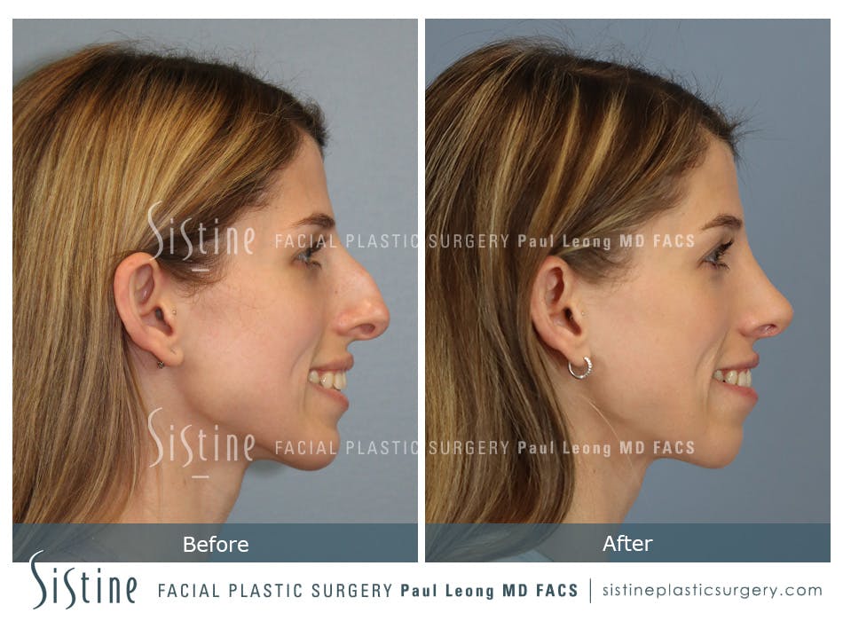 Rhinoplasty Before and After | Leong Facial Plastic Surgery