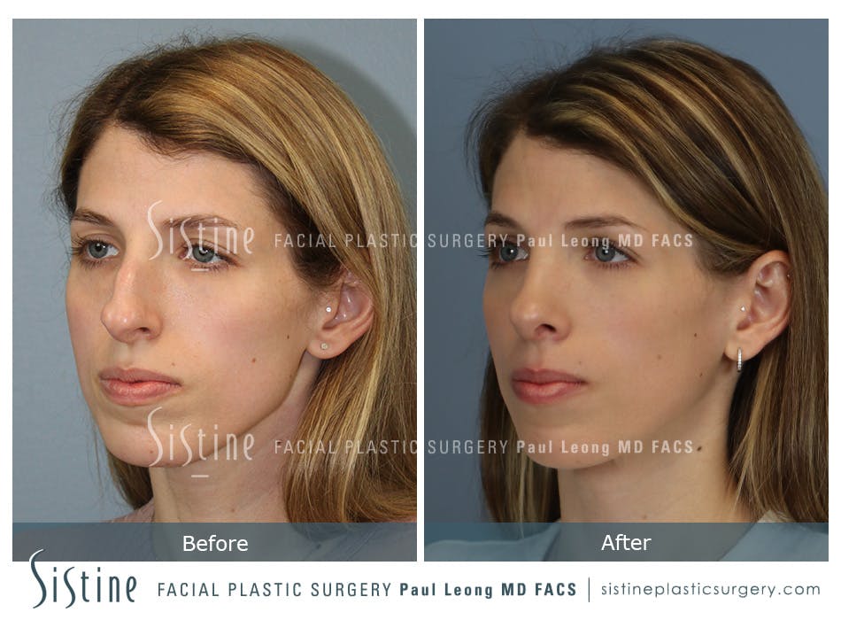Rhinoplasty Before and After | Leong Facial Plastic Surgery