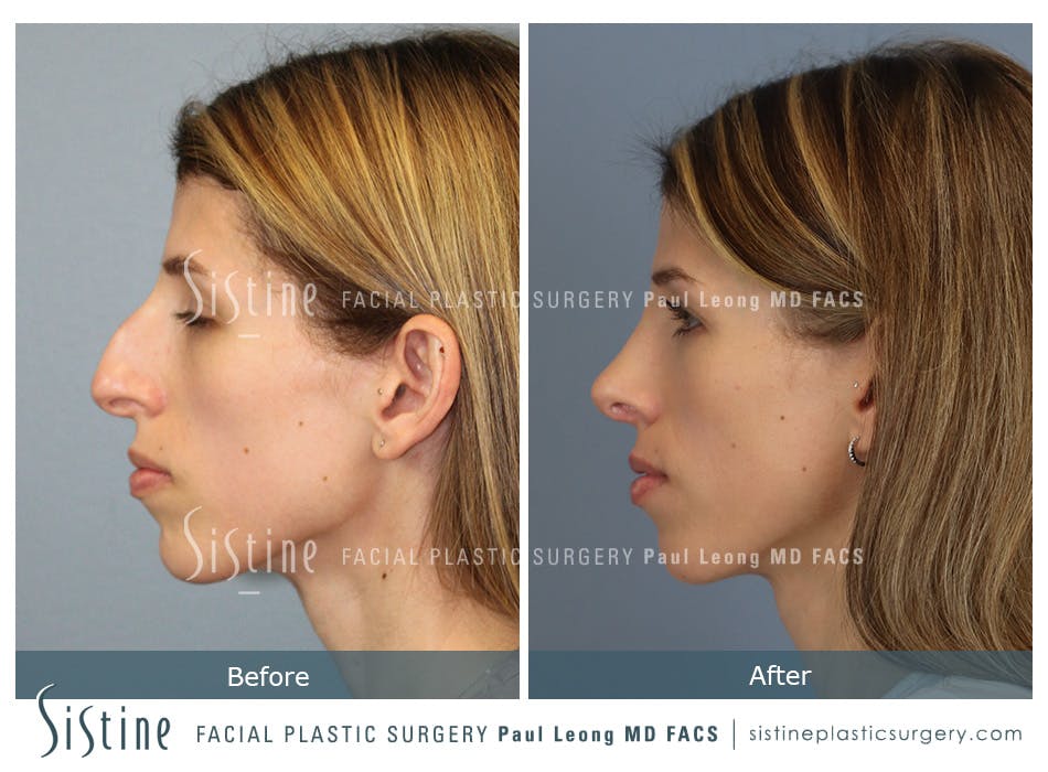 Rhinoplasty Before and After | Leong Facial Plastic Surgery