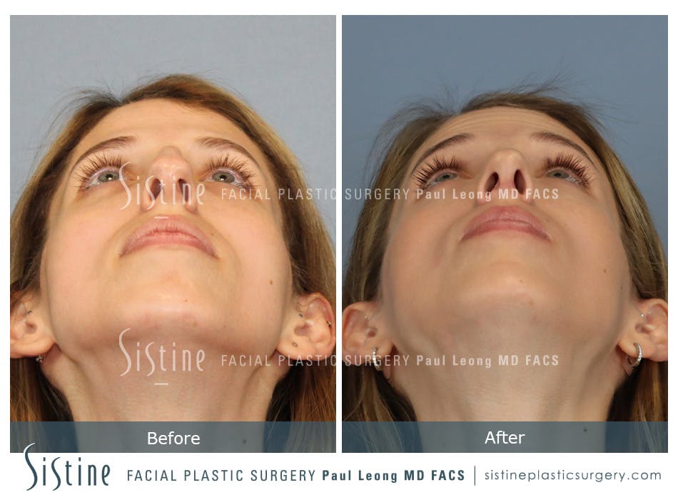 Rhinoplasty Before and After | Leong Facial Plastic Surgery