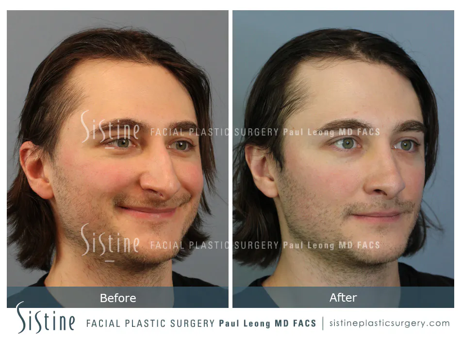 Rhinoplasty Before and After | Leong Facial Plastic Surgery