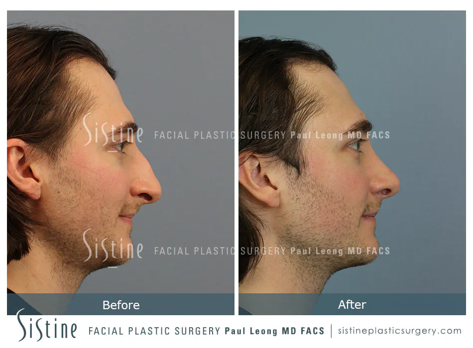 Rhinoplasty Before and After | Leong Facial Plastic Surgery