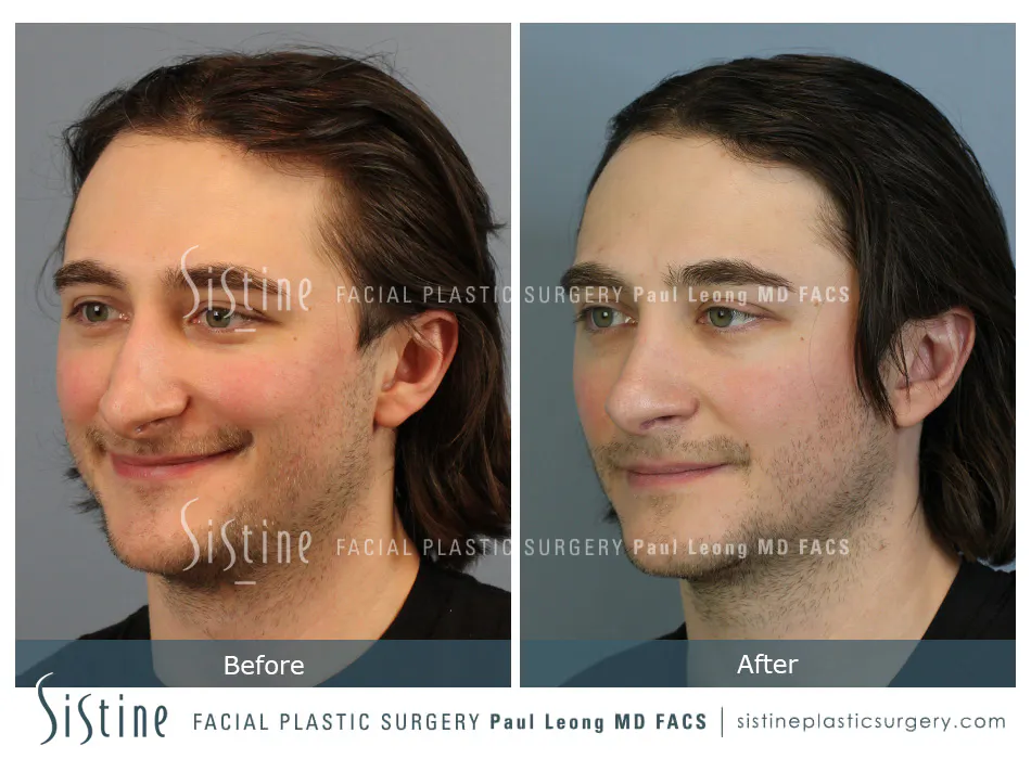 Rhinoplasty Before and After | Leong Facial Plastic Surgery