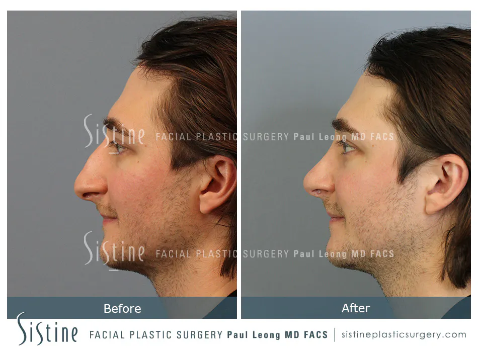 Rhinoplasty Before and After | Leong Facial Plastic Surgery