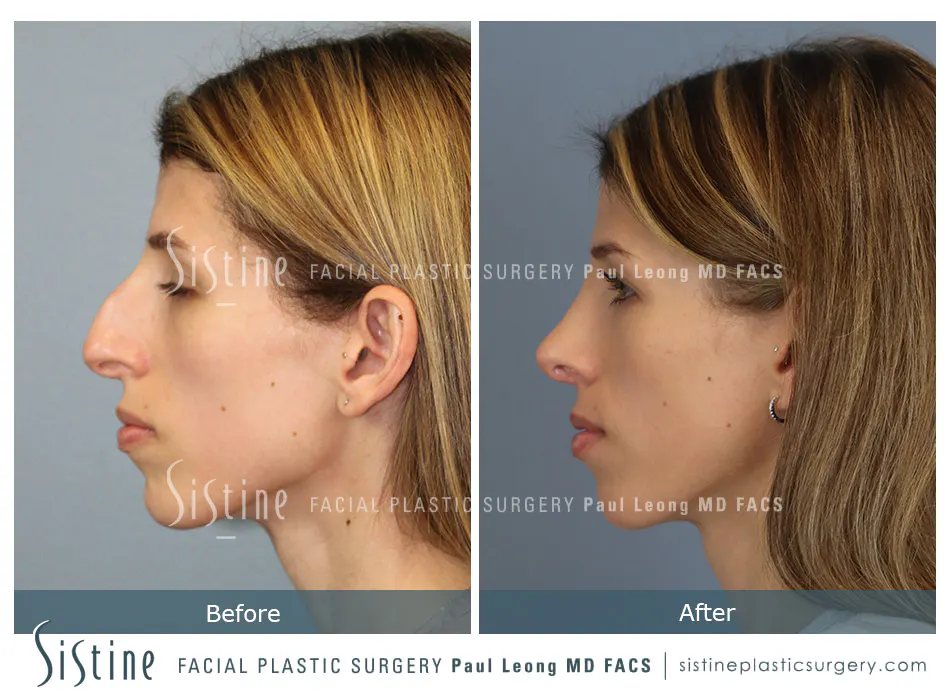 Female Rhinoplasty - Patient Preoperative View | Dr. Paul Leong