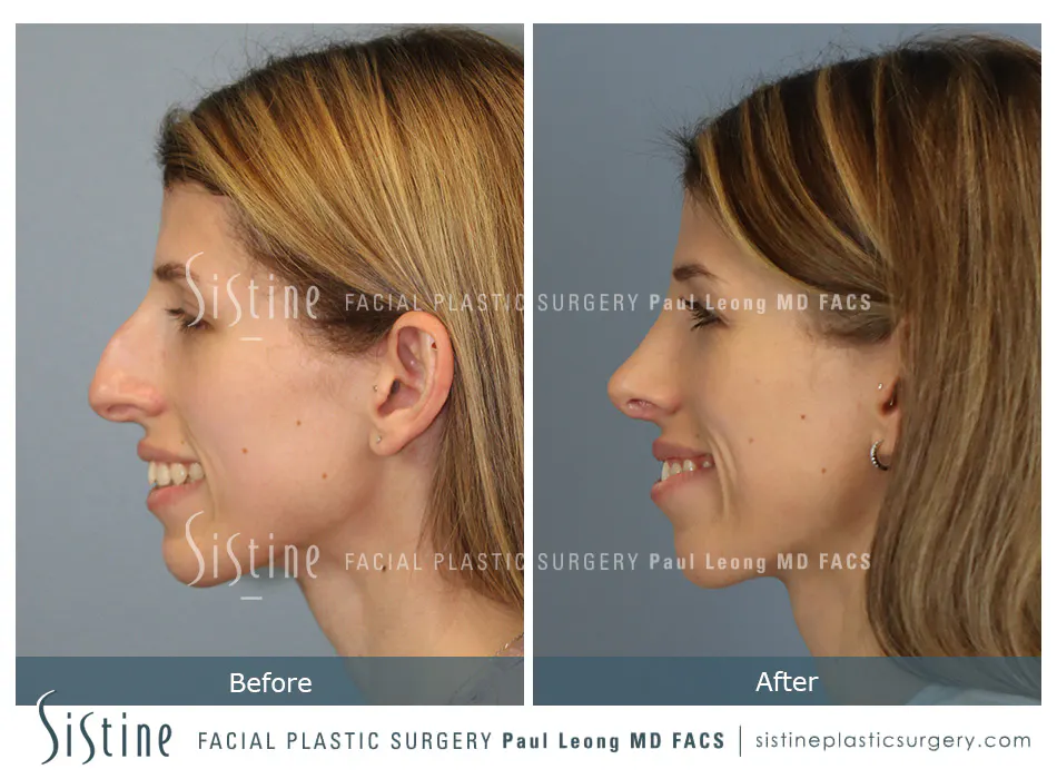 Female Rhinoplasty - Patient Preoperative View | Dr. Paul Leong