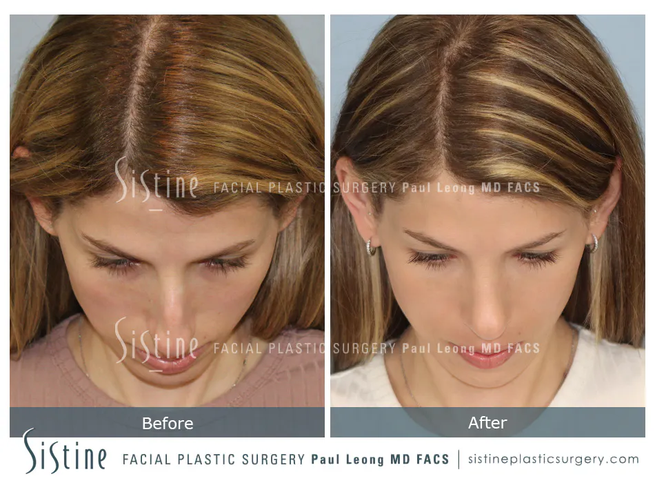 Female Rhinoplasty - Patient Preoperative View | Dr. Paul Leong