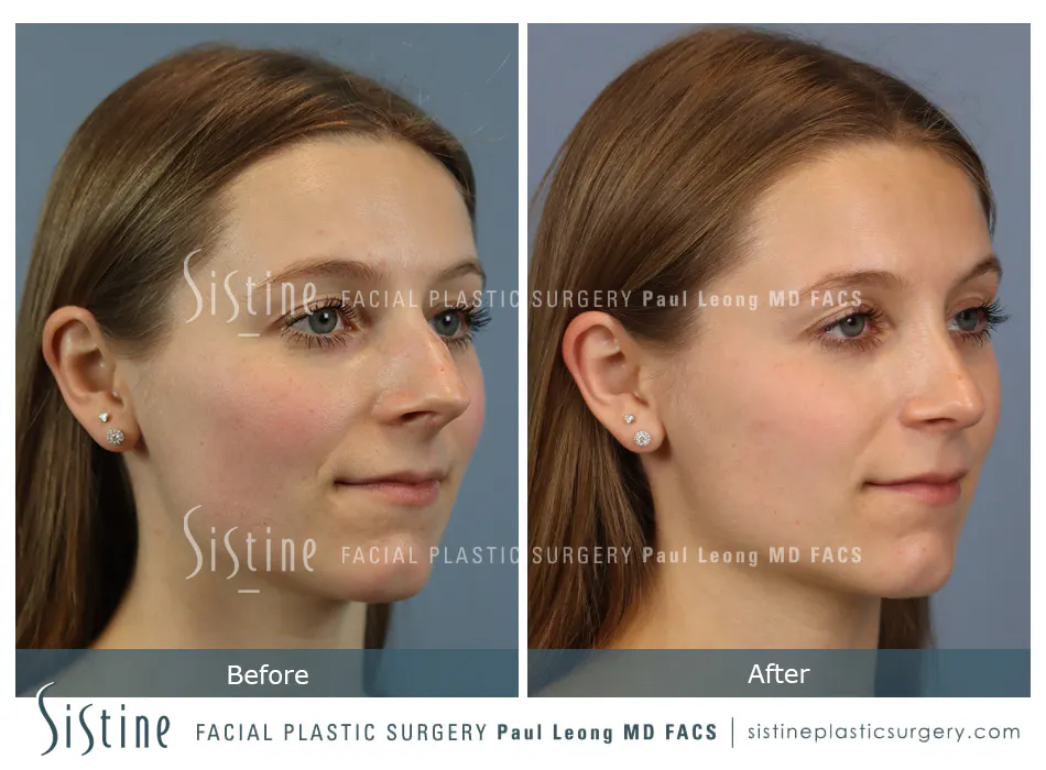 Rhinoplasty Before and After | Leong Facial Plastic Surgery