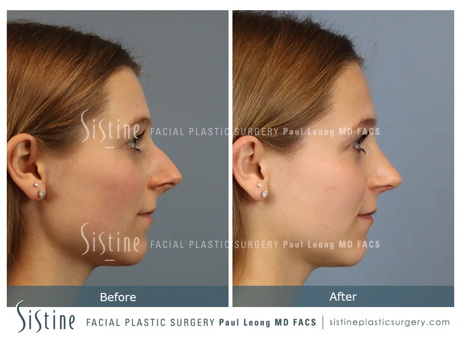 Rhinoplasty Before and After | Leong Facial Plastic Surgery