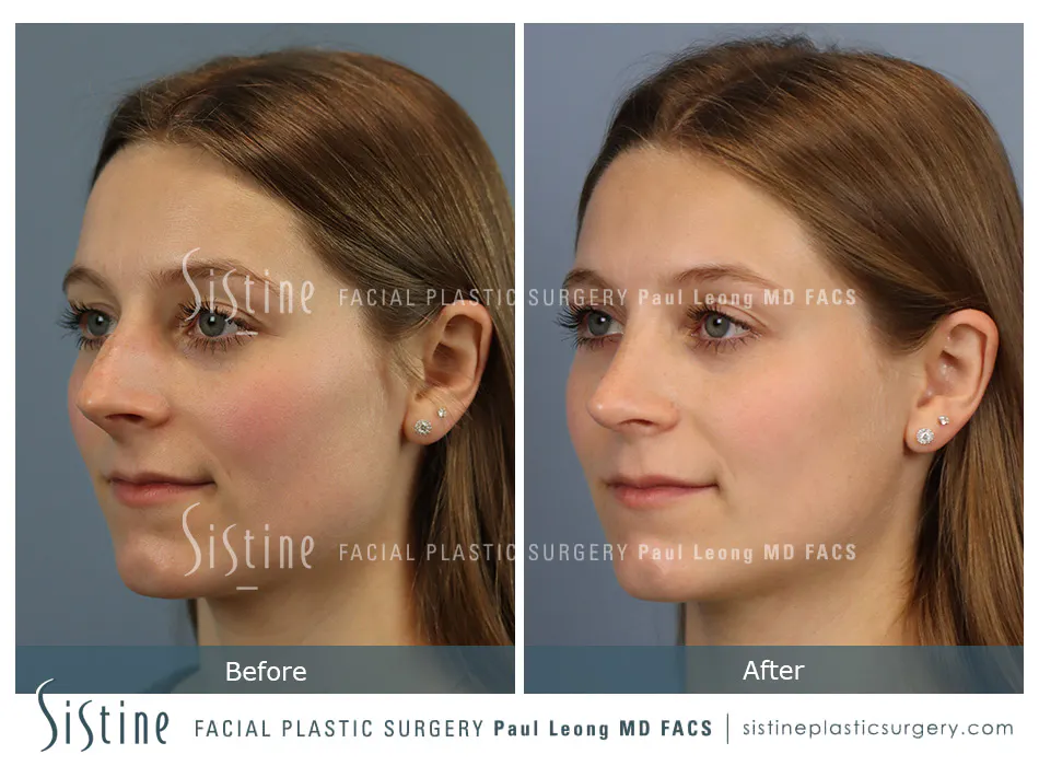 Rhinoplasty Before and After | Leong Facial Plastic Surgery