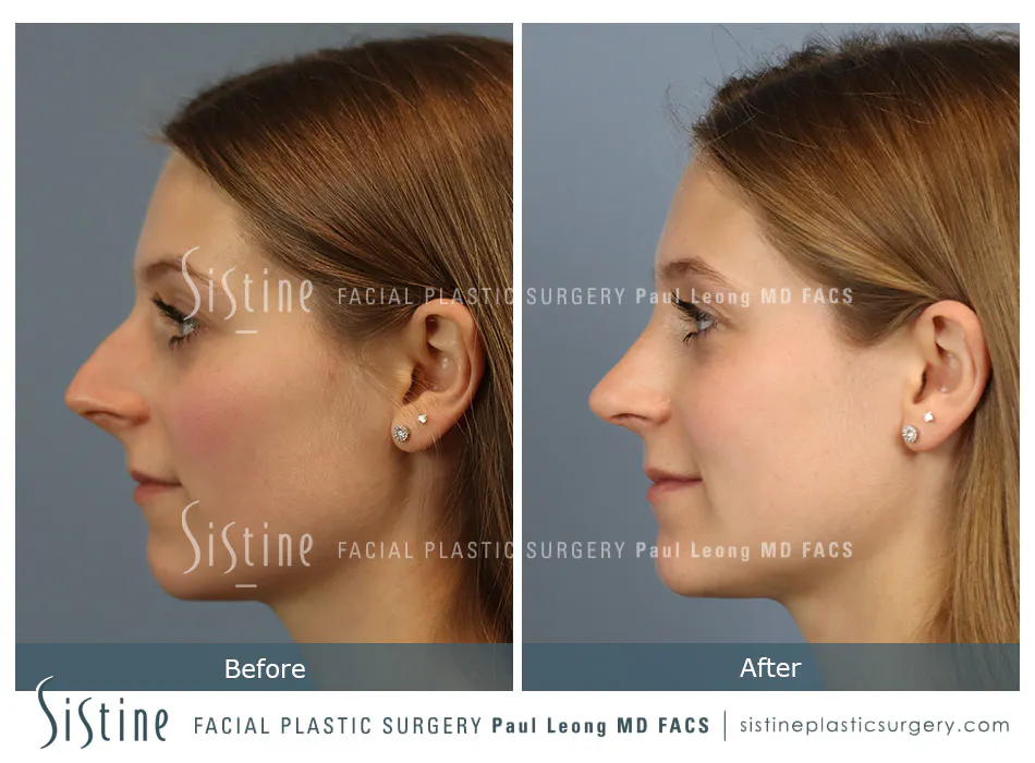 Rhinoplasty Before and After | Leong Facial Plastic Surgery