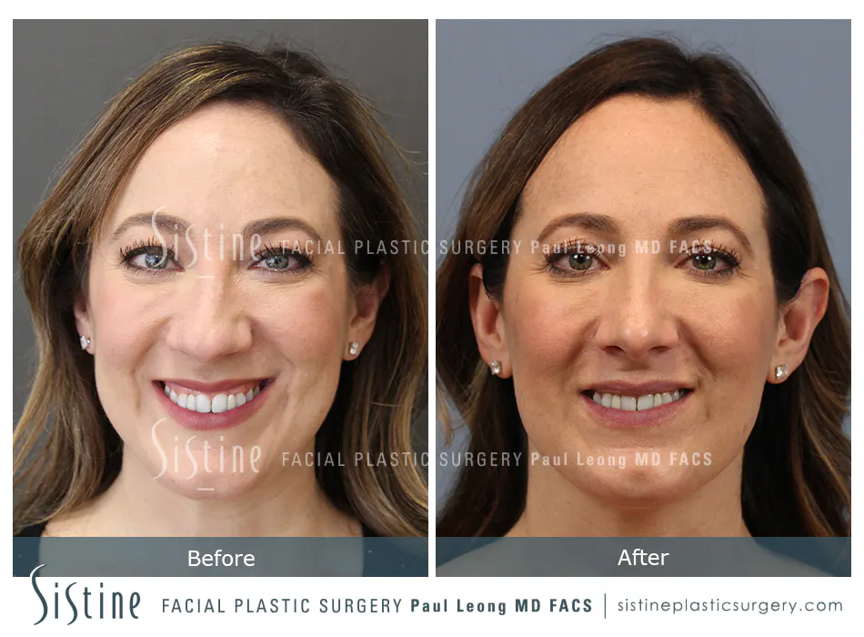 Rhinoplasty Before and After | Leong Facial Plastic Surgery