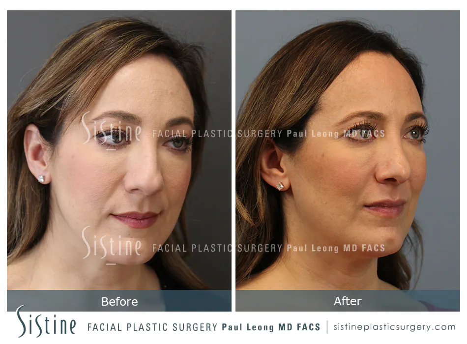 Rhinoplasty Before and After | Leong Facial Plastic Surgery
