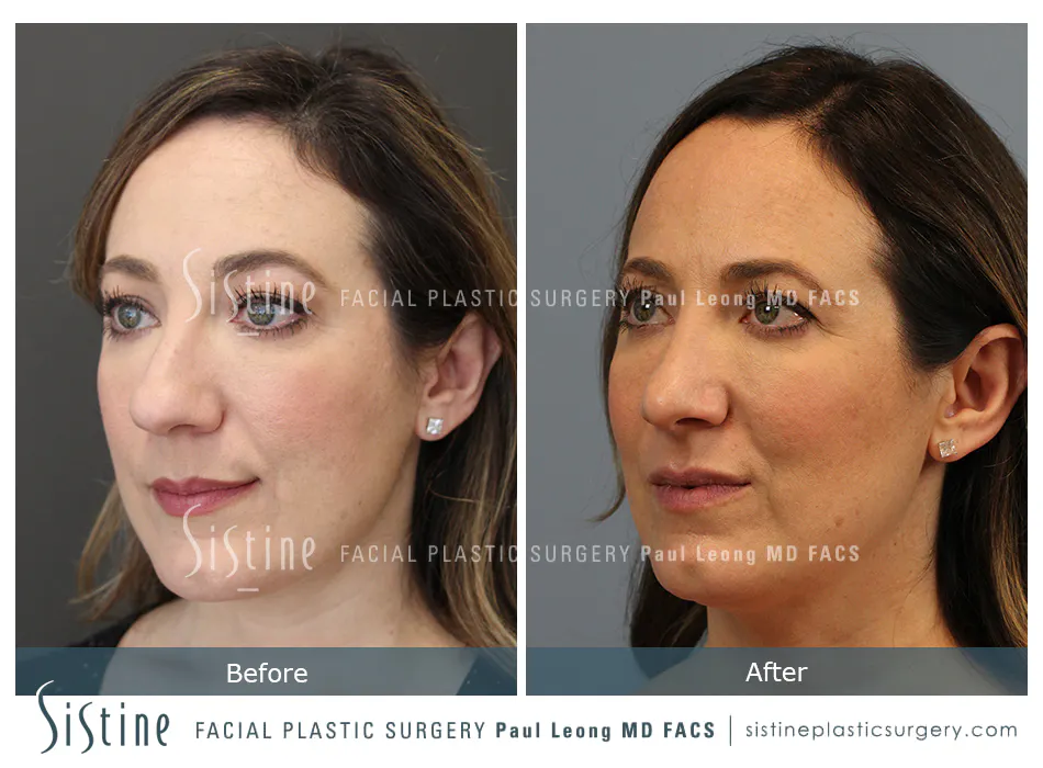 Rhinoplasty Before and After | Leong Facial Plastic Surgery