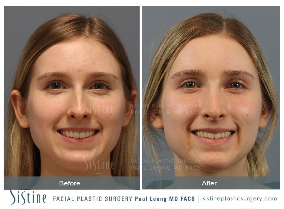 Rhinoplasty Before and After | Leong Facial Plastic Surgery
