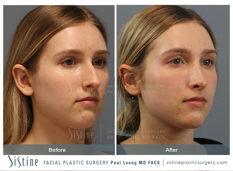 Rhinoplasty Before and After | Leong Facial Plastic Surgery